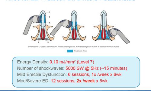  ESWT -Stoßwellentherapie bei Erektionsstörungen oder IPP